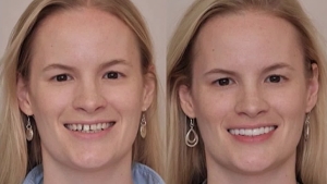 facelift+dentistry